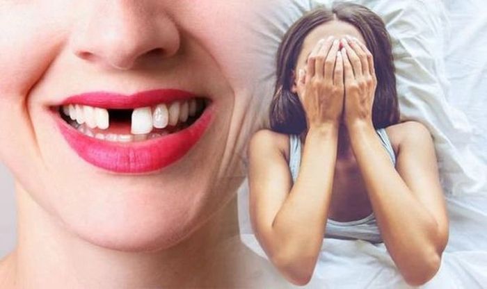 Mơ thấy rụng 1 chiếc răng cửa là điềm báo về một mất mát nhỏ